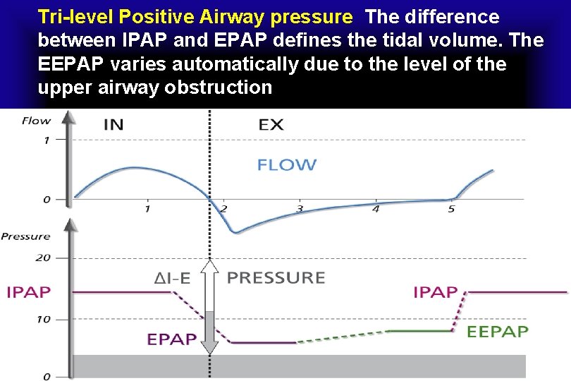Tri-level Positive Airway pressure The difference between IPAP and EPAP defines the tidal volume.