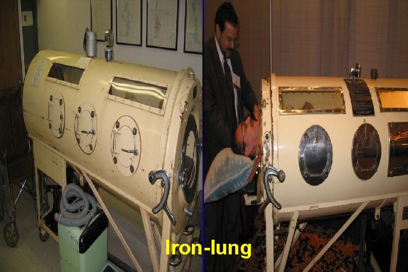 Iron-lung 