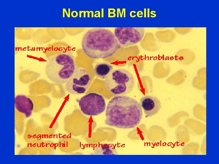Normal BM cells 