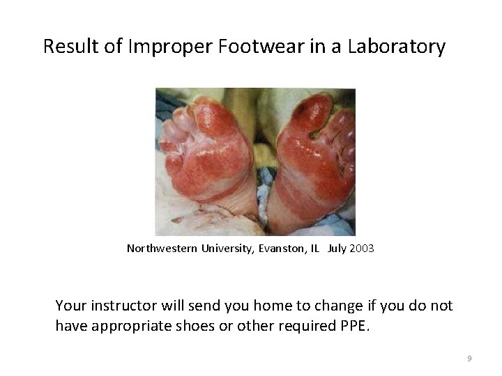 Result of Improper Footwear in a Laboratory Northwestern University, Evanston, IL July 2003 Your