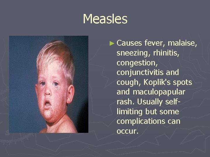 Measles ► Causes fever, malaise, sneezing, rhinitis, congestion, conjunctivitis and cough, Koplik's spots and
