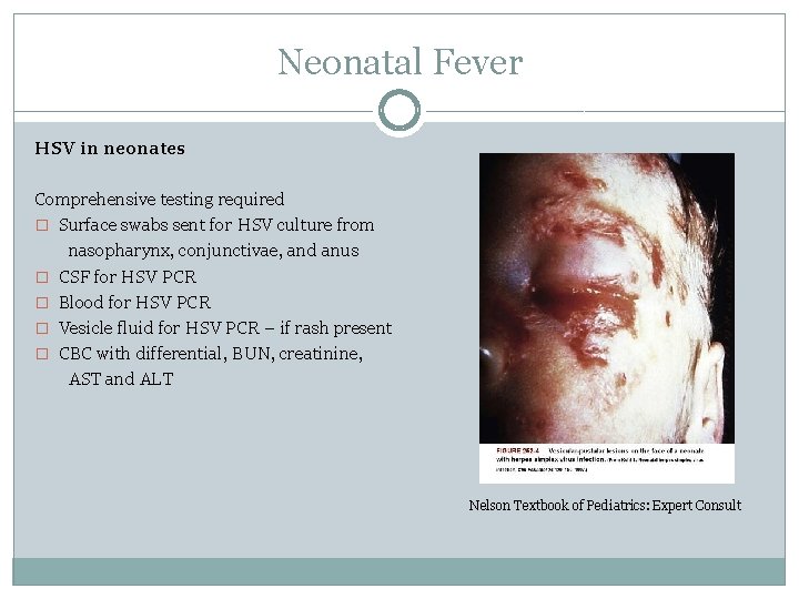 Neonatal Fever HSV in neonates Comprehensive testing required � Surface swabs sent for HSV