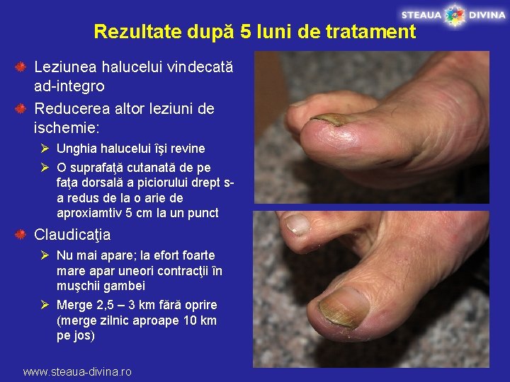 Rezultate după 5 luni de tratament Leziunea halucelui vindecată ad-integro Reducerea altor leziuni de