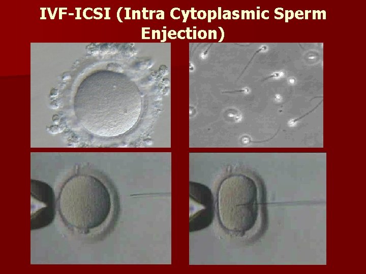 IVF-ICSI (Intra Cytoplasmic Sperm Enjection) 