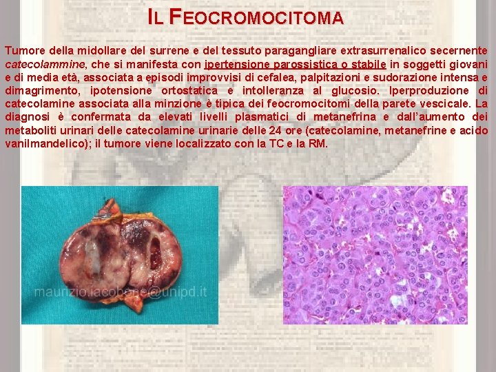 IL FEOCROMOCITOMA Tumore della midollare del surrene e del tessuto paragangliare extrasurrenalico secernente catecolammine,