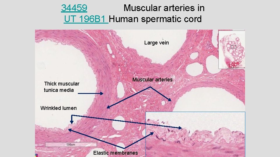 34459 Muscular arteries in UT 196 B 1 Human spermatic cord Large vein Thick
