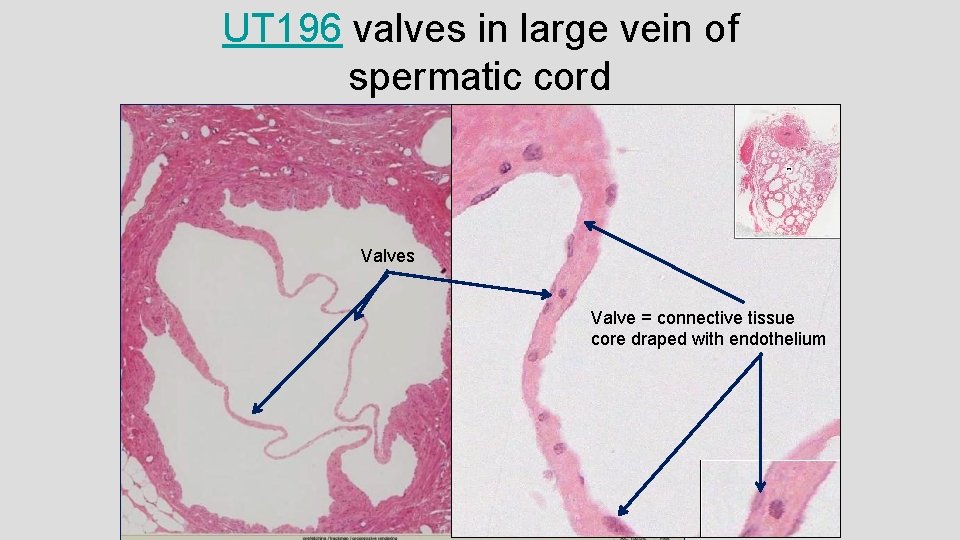 UT 196 valves in large vein of spermatic cord Valves Valve = connective tissue