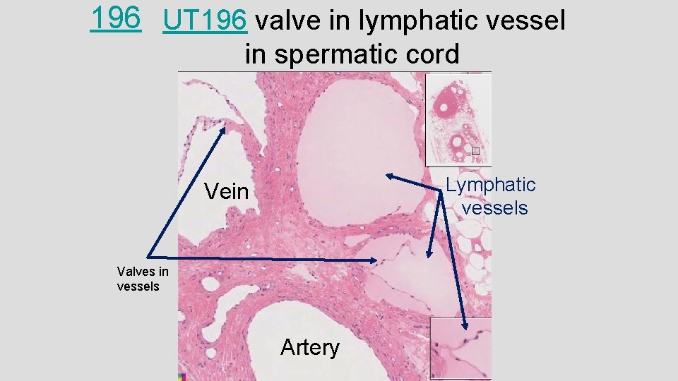 196 UT 196 valve in lymphatic vessel in spermatic cord Lymphatic vessels Vein Valves