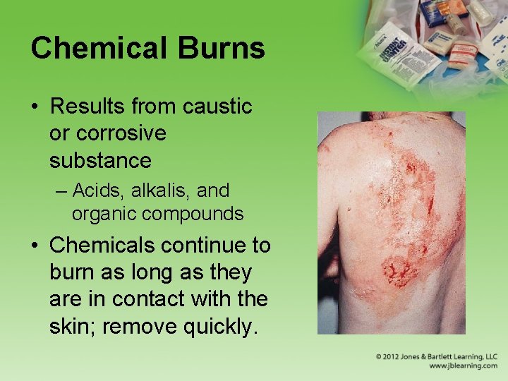 Chemical Burns • Results from caustic or corrosive substance – Acids, alkalis, and organic