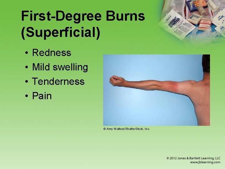 First-Degree Burns (Superficial) • • Redness Mild swelling Tenderness Pain © Amy Walters/Shutter. Stock,