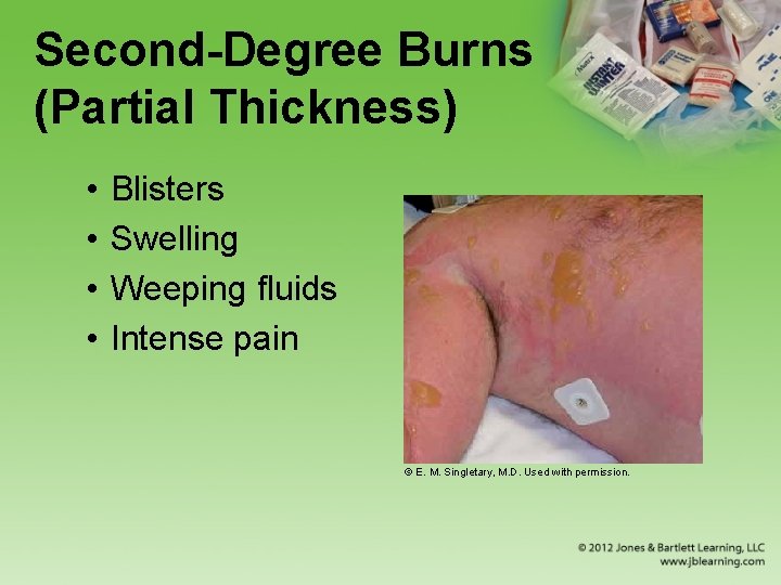 Second-Degree Burns (Partial Thickness) • • Blisters Swelling Weeping fluids Intense pain © E.