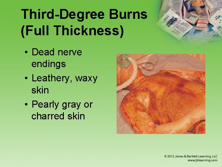 Third-Degree Burns (Full Thickness) • Dead nerve endings • Leathery, waxy skin • Pearly