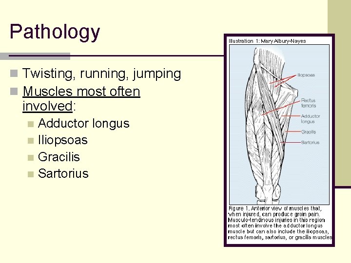 Pathology n Twisting, running, jumping n Muscles most often involved: Adductor longus n Iliopsoas