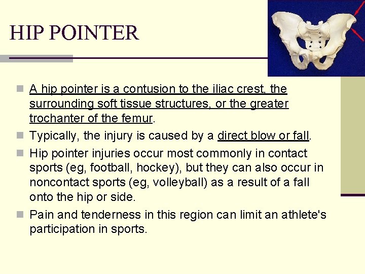 HIP POINTER n A hip pointer is a contusion to the iliac crest, the