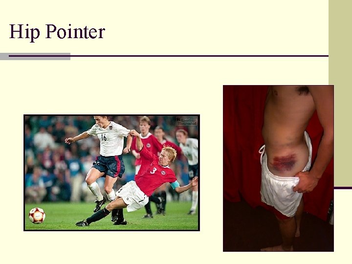 Hip Pointer 