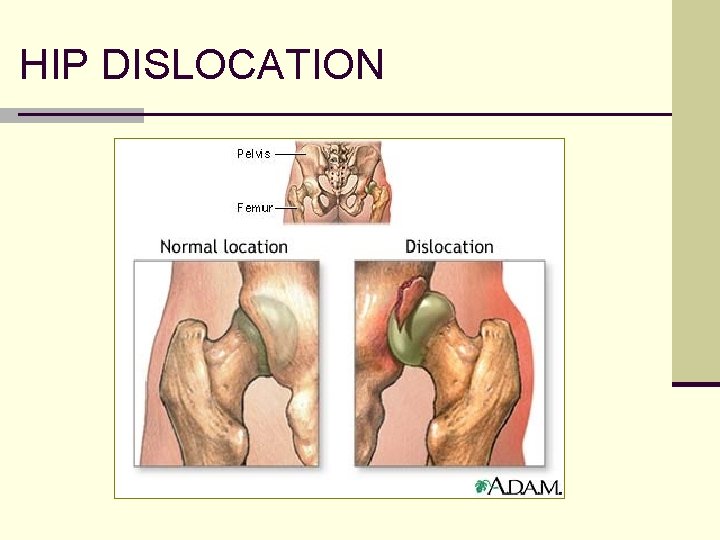HIP DISLOCATION 