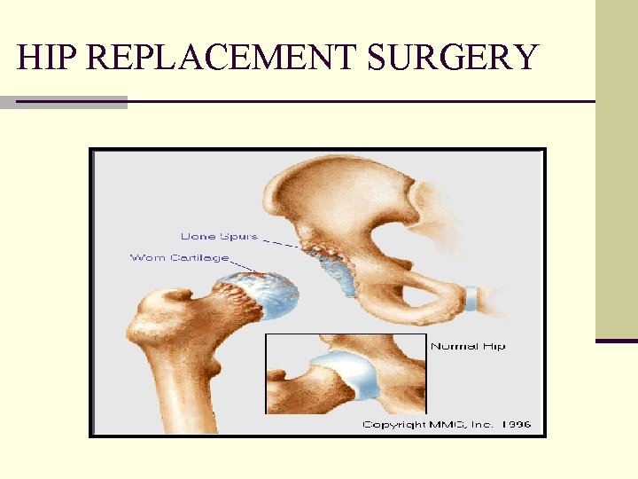 HIP REPLACEMENT SURGERY 