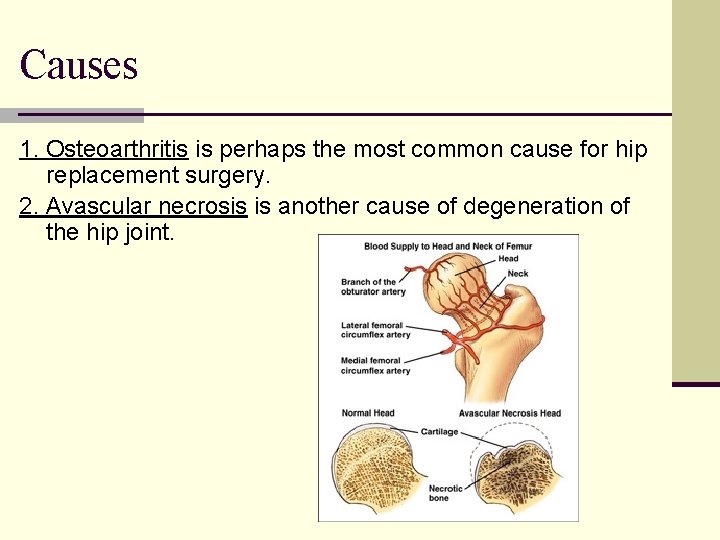 Causes 1. Osteoarthritis is perhaps the most common cause for hip replacement surgery. 2.