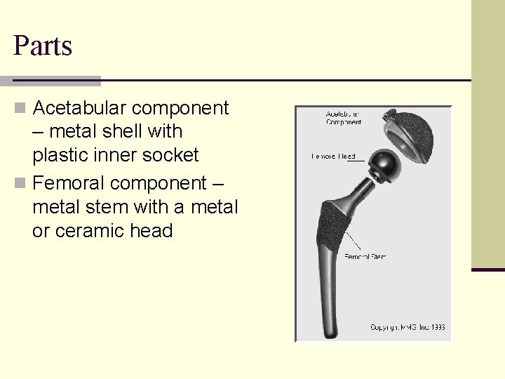 Parts n Acetabular component – metal shell with plastic inner socket n Femoral component