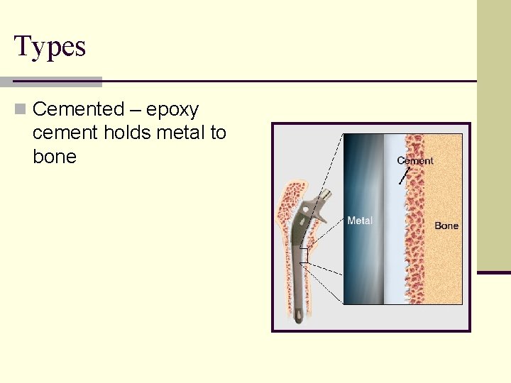 Types n Cemented – epoxy cement holds metal to bone 