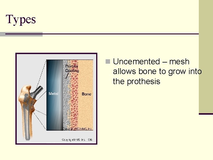 Types n Uncemented – mesh allows bone to grow into the prothesis 