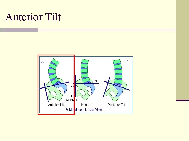 Anterior Tilt 