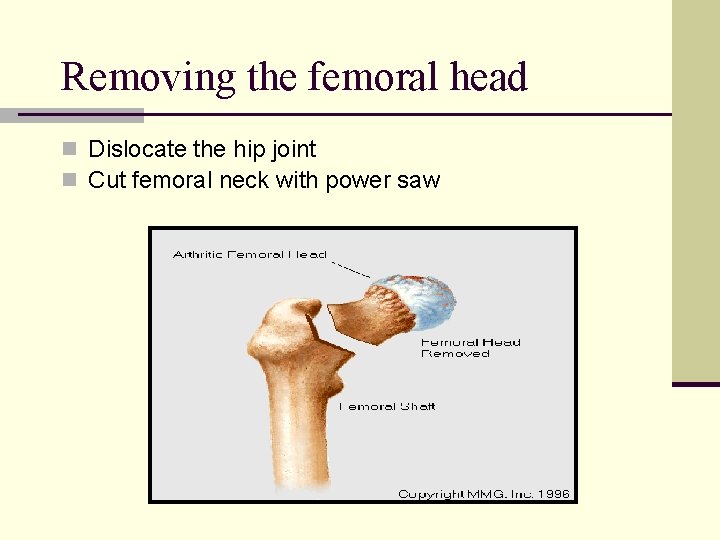 Removing the femoral head n Dislocate the hip joint n Cut femoral neck with