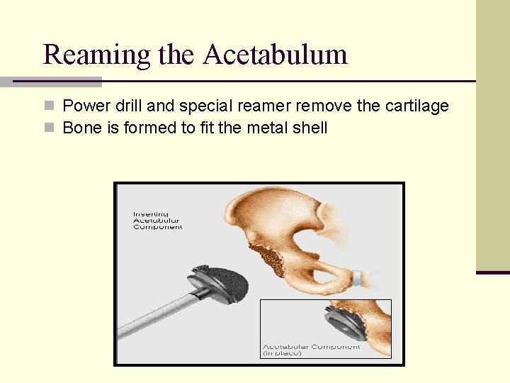 Reaming the Acetabulum n Power drill and special reamer remove the cartilage n Bone