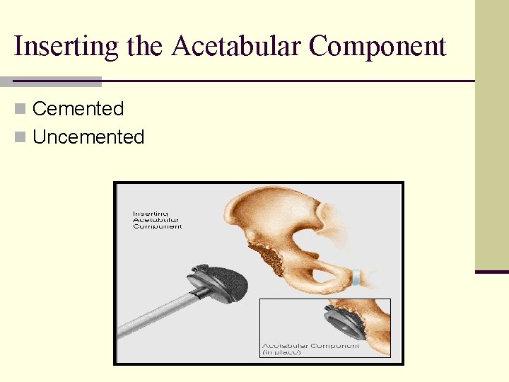 Inserting the Acetabular Component n Cemented n Uncemented 