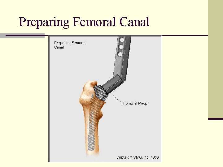 Preparing Femoral Canal 