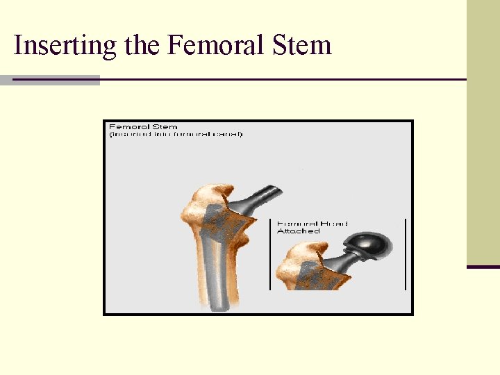 Inserting the Femoral Stem 