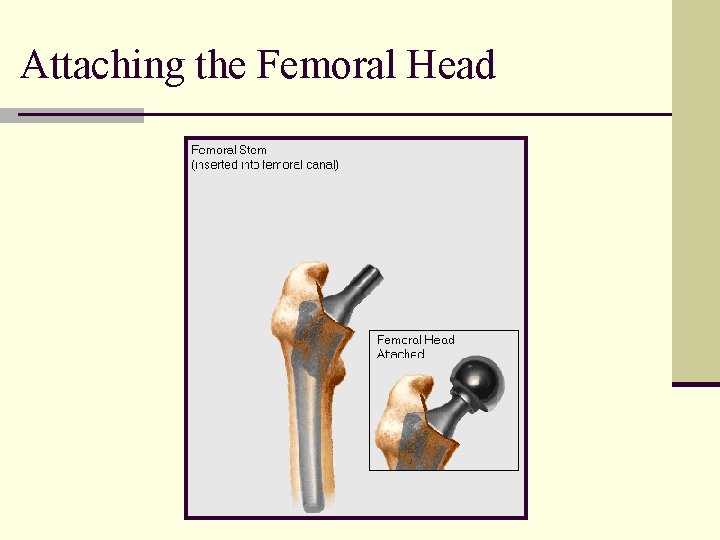 Attaching the Femoral Head 