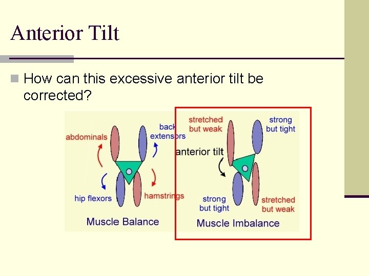 Anterior Tilt n How can this excessive anterior tilt be corrected? 