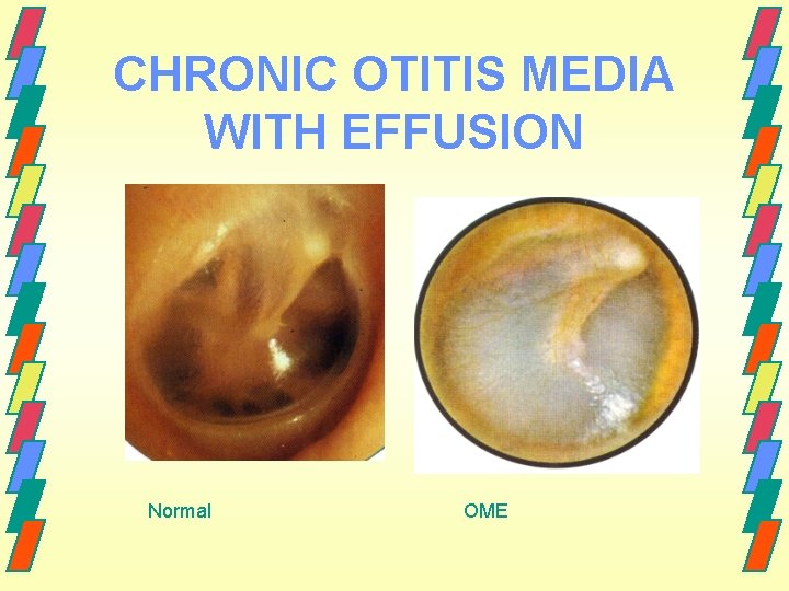 CHRONIC OTITIS MEDIA WITH EFFUSION Normal OME 
