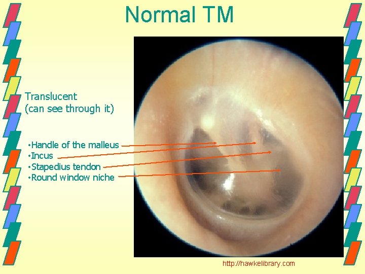 Normal TM Translucent (can see through it) • Handle of the malleus • Incus