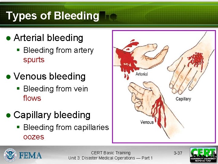 Types of Bleeding ● Arterial bleeding § Bleeding from artery spurts. ● Venous bleeding
