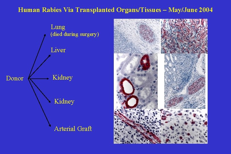 Human Rabies Via Transplanted Organs/Tissues – May/June 2004 Lung (died during surgery) Liver Donor