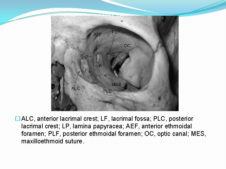 � ALC, anterior lacrimal crest; LF, lacrimal fossa; PLC, posterior lacrimal crest; LP, lamina