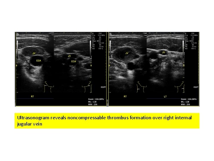 Ultrasonogram reveals noncompressable thrombus formation over right internal jugular vein 