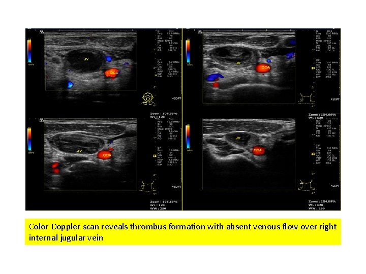 Color Doppler scan reveals thrombus formation with absent venous flow over right internal jugular