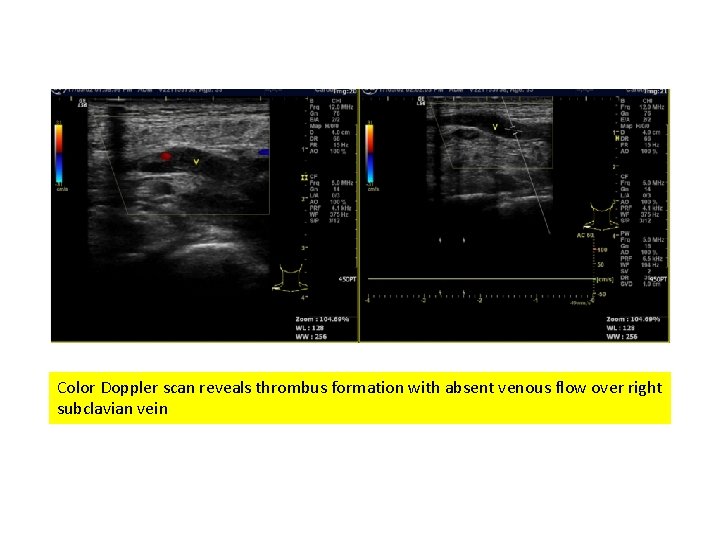 Color Doppler scan reveals thrombus formation with absent venous flow over right subclavian vein