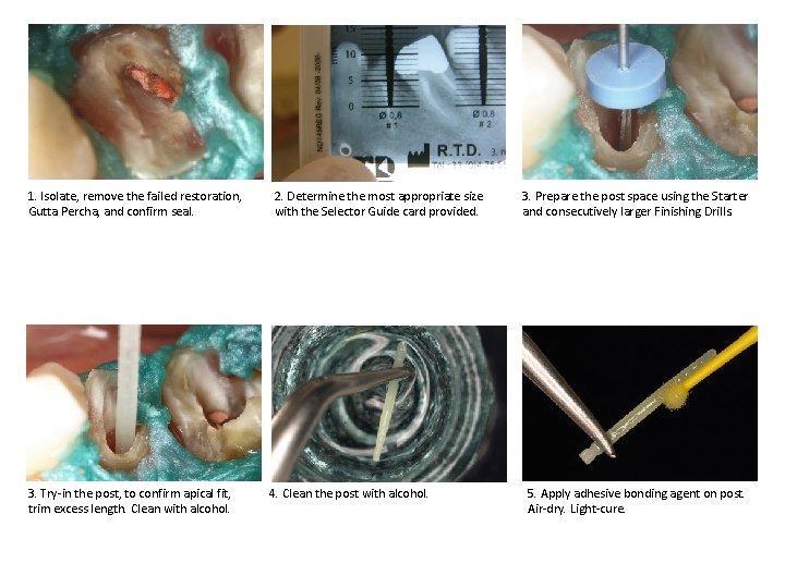 1. Isolate, remove the failed restoration, Gutta Percha, and confirm seal. 3. Try-in the