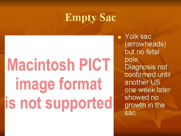 Empty Sac n Yolk sac (arrowheads) but no fetal pole. Diagnosis not confirmed until
