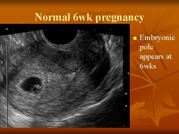Normal 6 wk pregnancy n Embryonic pole appears at 6 wks 