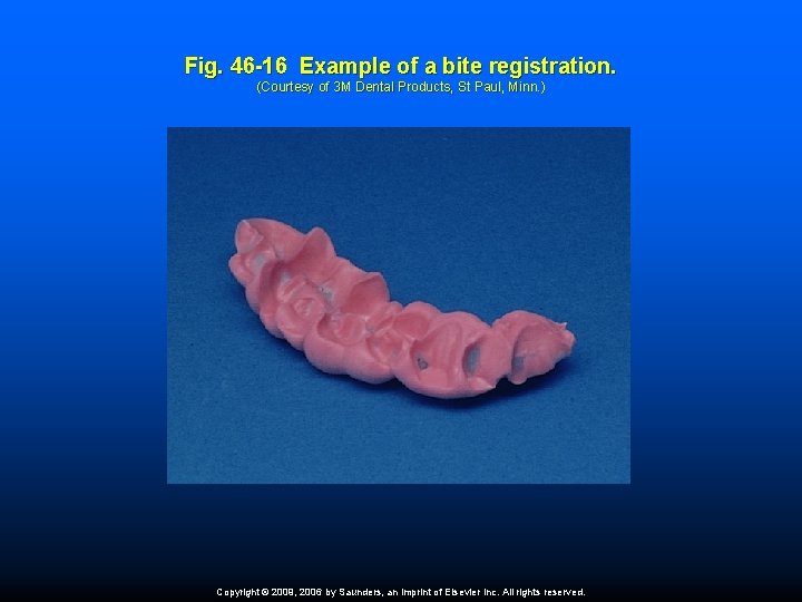 Fig. 46 -16 Example of a bite registration. (Courtesy of 3 M Dental Products,