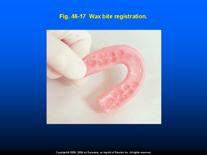 Fig. 46 -17 Wax bite registration. Copyright © 2009, 2006 by Saunders, an imprint