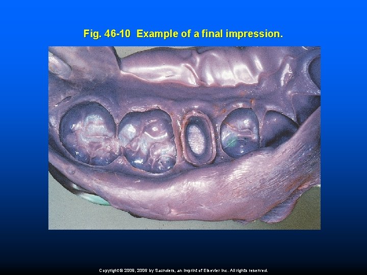 Fig. 46 -10 Example of a final impression. Copyright © 2009, 2006 by Saunders,