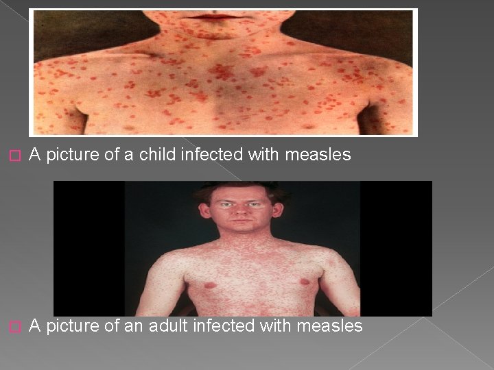 � A picture of a child infected with measles � A picture of an