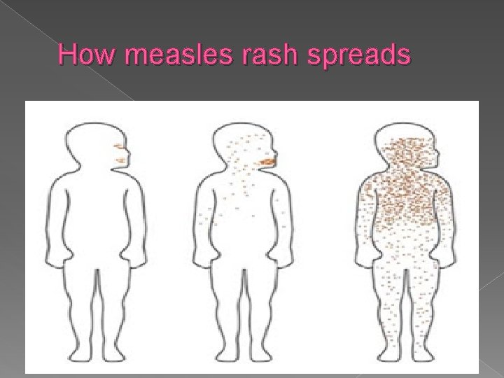 How measles rash spreads 