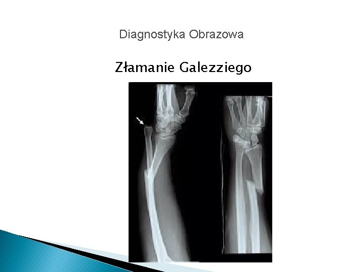 Diagnostyka Obrazowa Złamanie Galezziego 